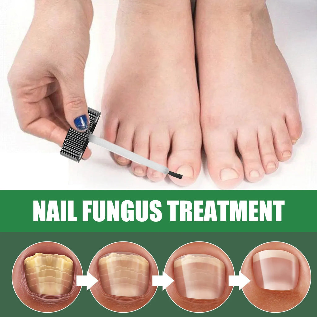 30ml bottle of tea tree oil nail repair solution for hand and foot care